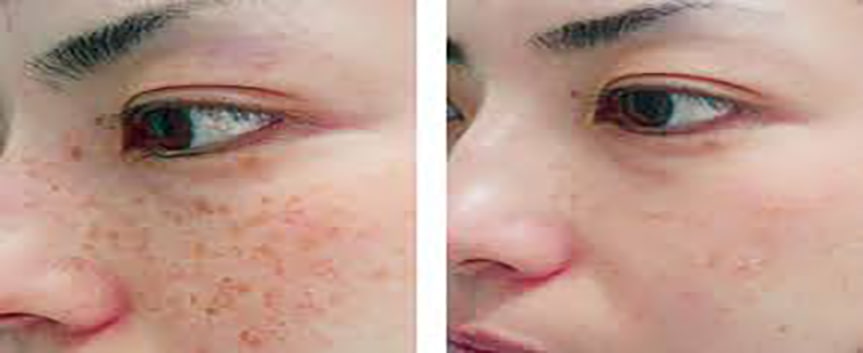  قبل و بعد از درمان لکه های پوست صورت